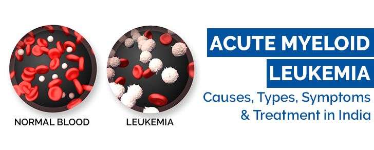 Acute Myeloid Leukemia